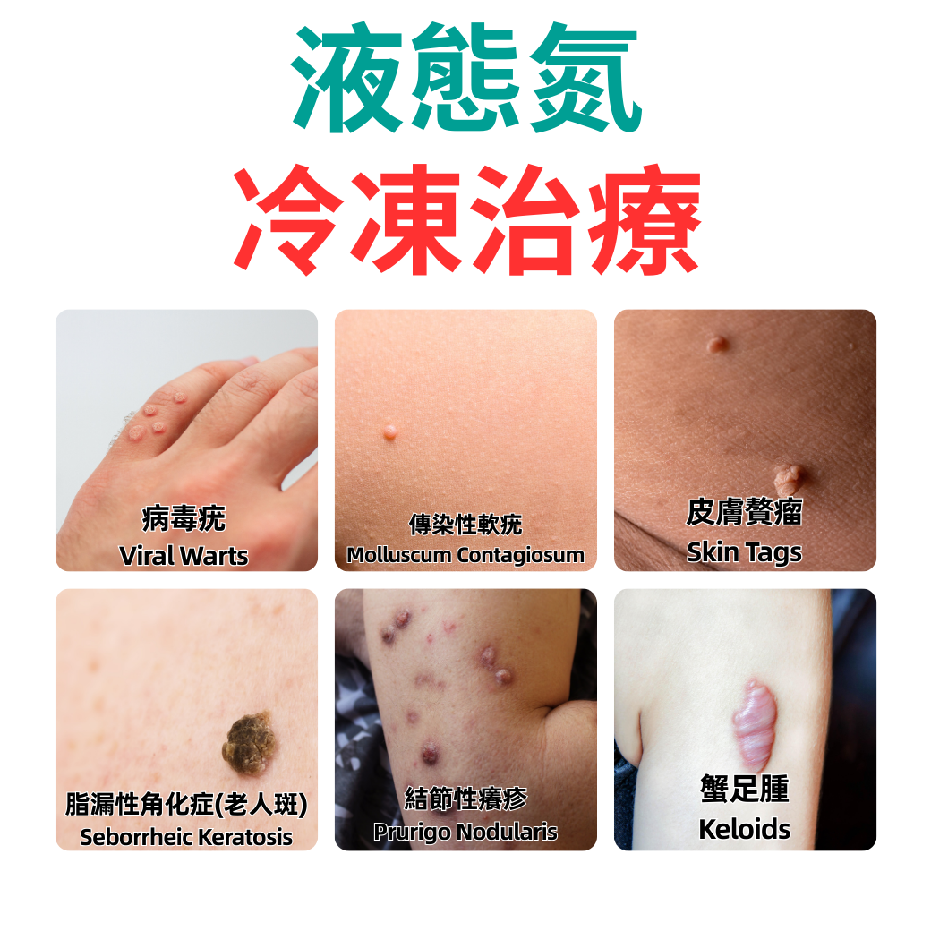 液態氮冷凍治療